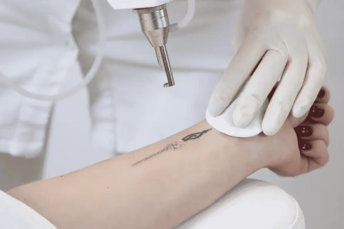 Laser Tattoo Removal by Optimal Health Family Practice & Medspa