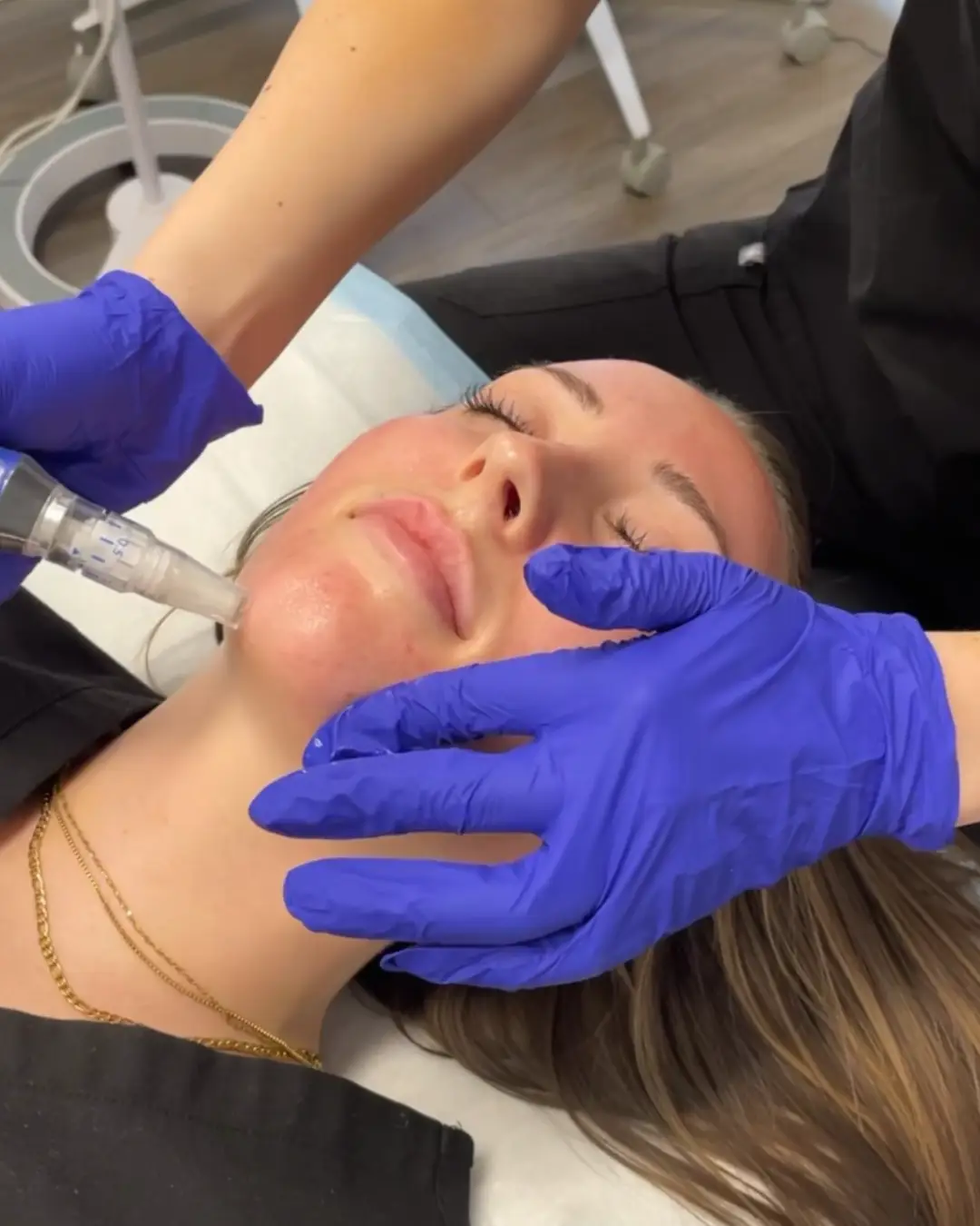 Close-up of a woman receiving a professional microneedling treatment at Optimal Health Family Practice Medspa in Provo, UT