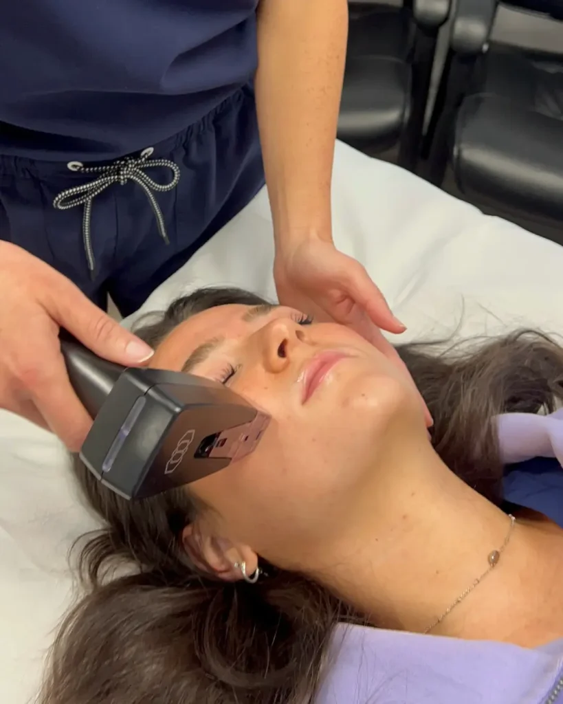 Close-up of a woman receiving a Morpheus8 treatment on her face in Provo, UT.