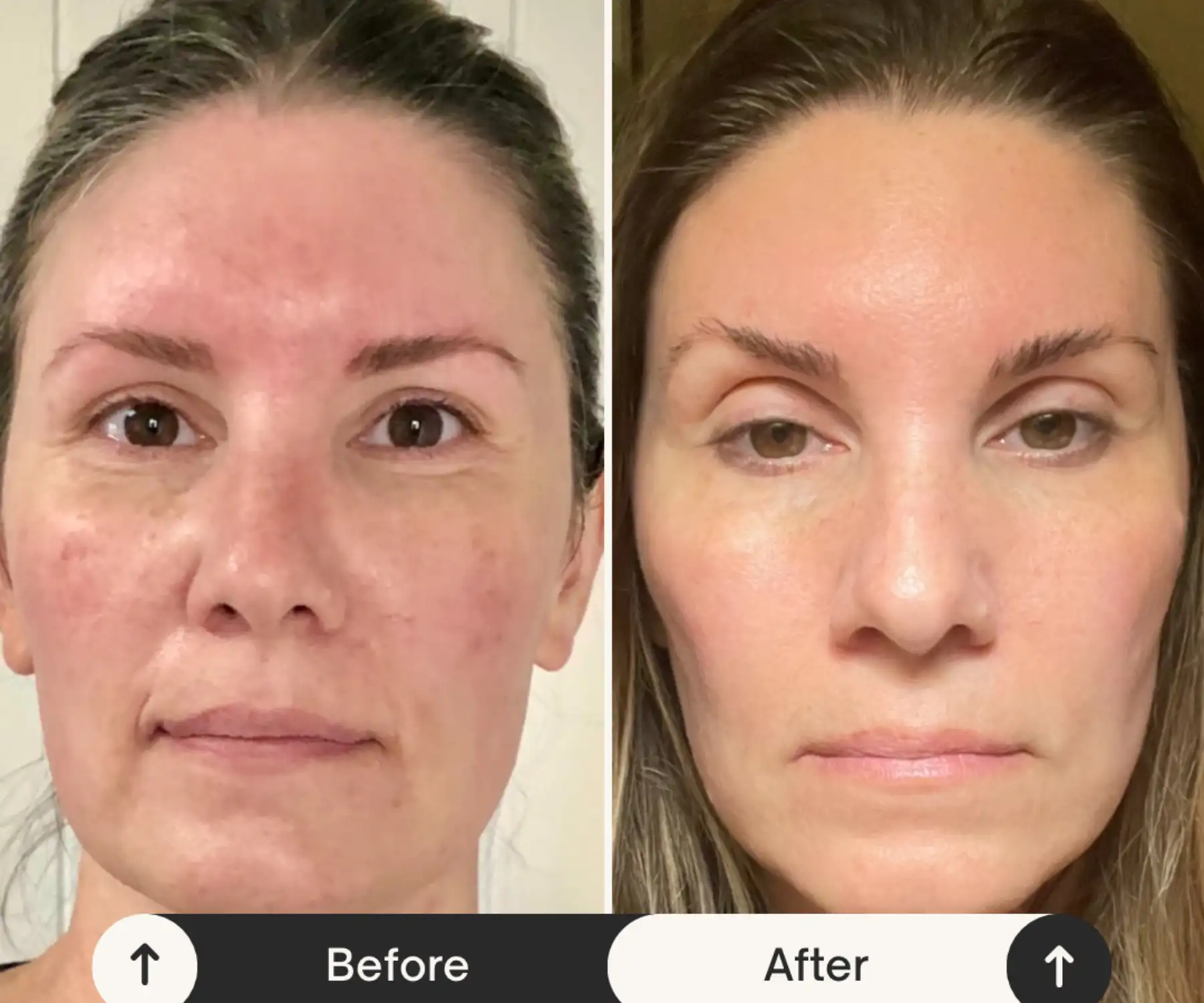 before-and-after-img-in-Optimal-Health-Family-Practice-Medspa-Provo-UT