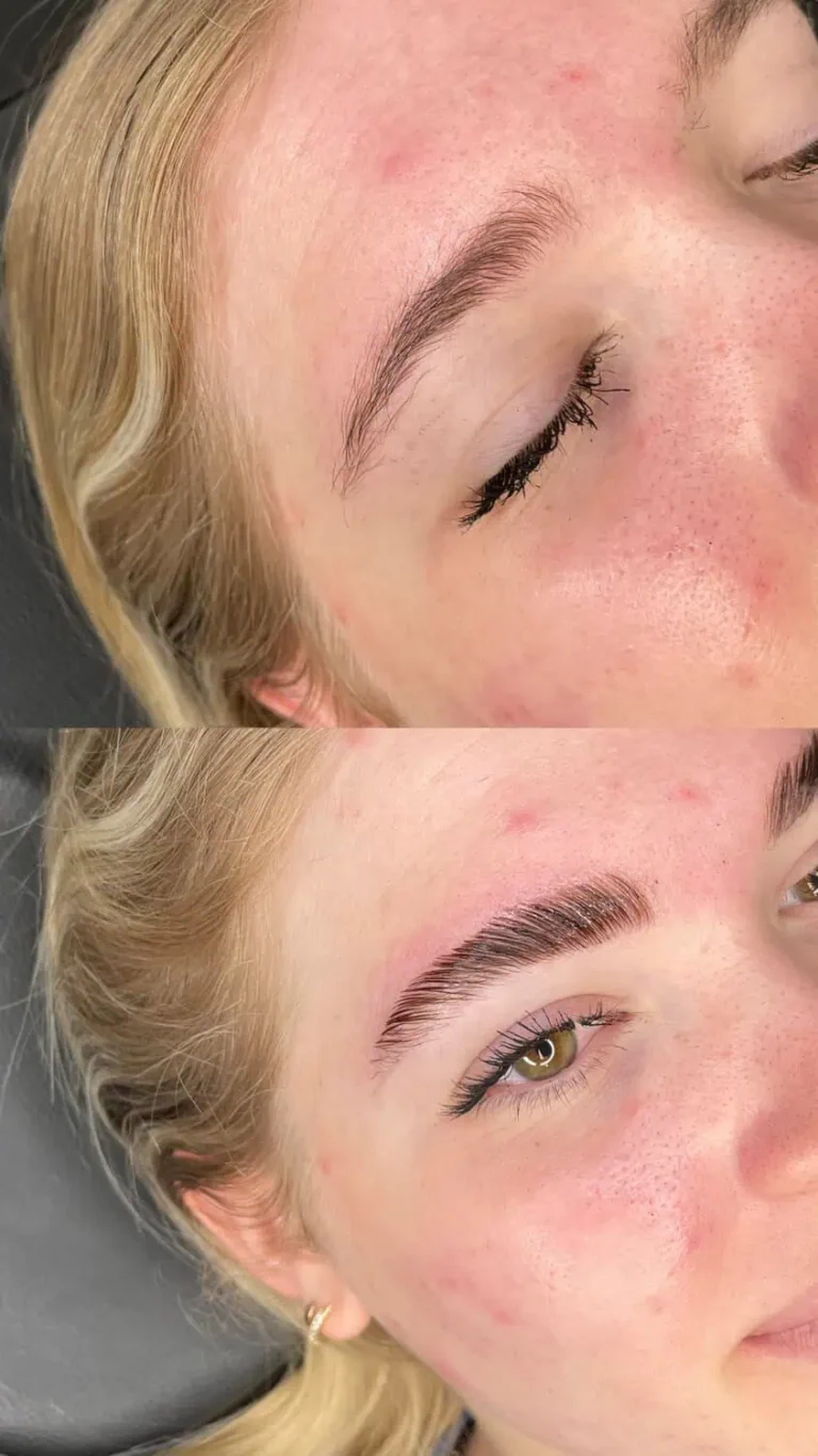 Before-and-After-img-eyes-left-in-Optimal-Health-Family-Practice-Medspa-Provo-UT