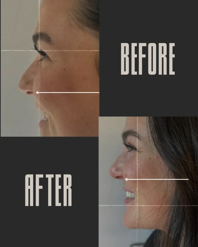 Before-and-After-img-smile-in-Optimal-Health-Family-Practice-Medspa-Provo-UT