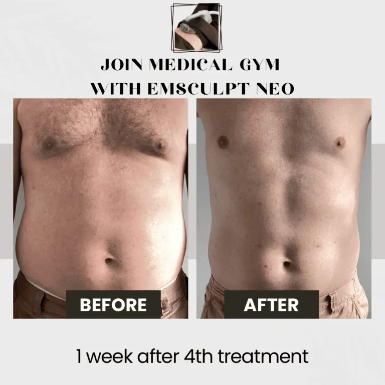 Before-and-After-weight-loss-in-Optimal-Health-Family-Practice-Medspa-Provo-UT