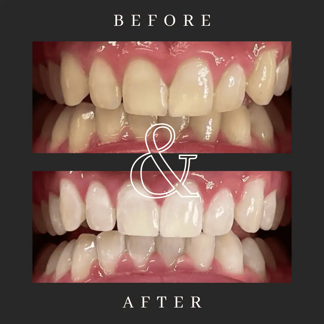 Black-and-White-Lash-Tech-Before-and-After-in-Optimal-Health-Family-Practice-Medspa-Provo-UT