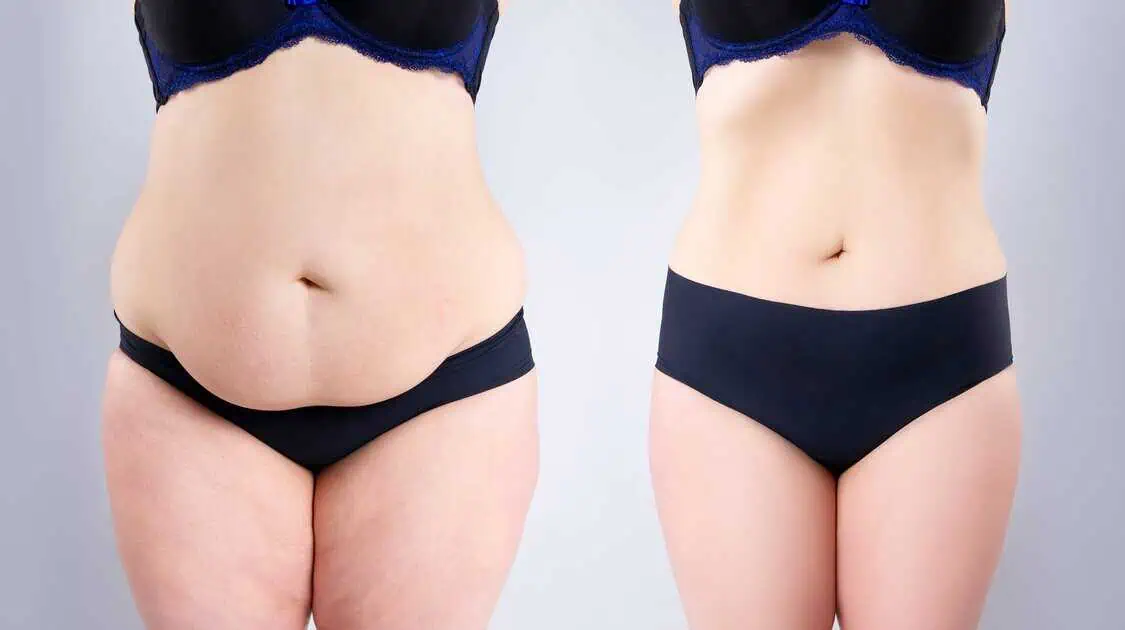 EmSculpt Neo in Provo, UT by Optimal Health Family Practice & Medspa