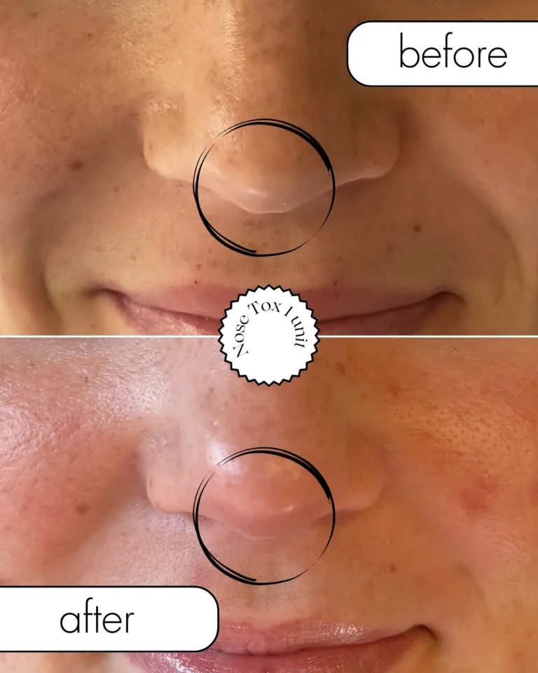 Nose-Tox-Before-and-After-img-face-eye-left-in-Optimal-Health-Family-Practice-Medspa-Provo-UT