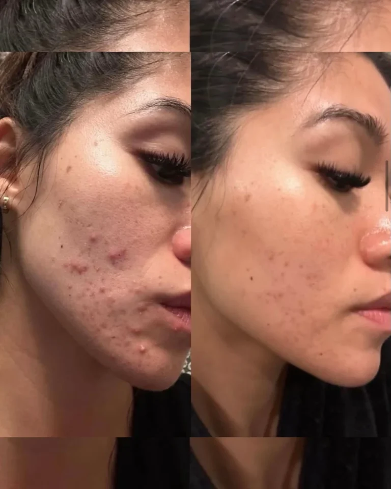 The-Perfect-Derma-Peel-Acbe-treatment-Before-and-After-in-Optimal-Health-Family-Practice-Medspa-Provo-UT
