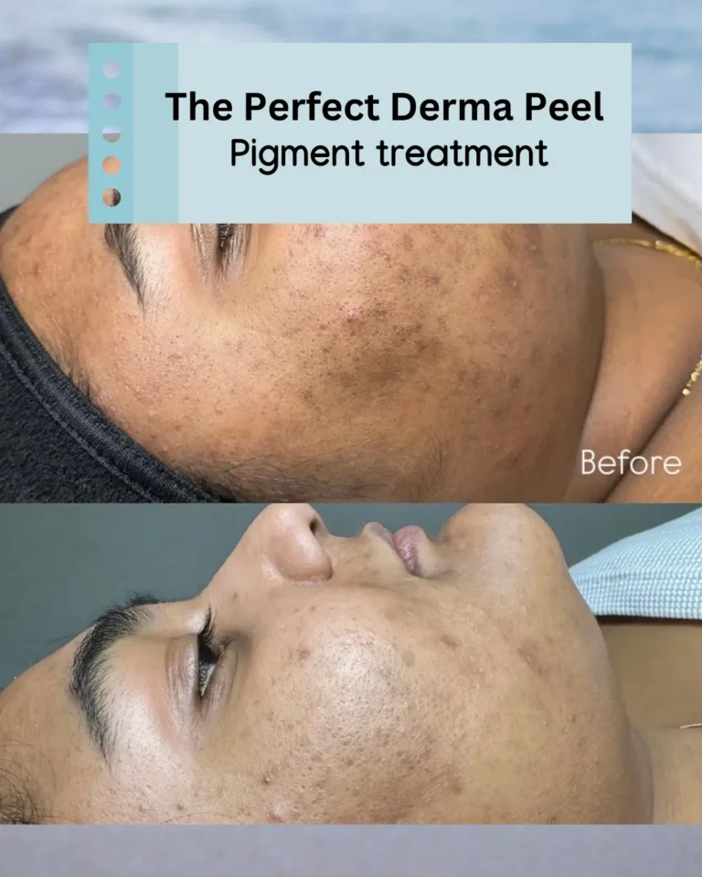treatment-Before-and-After-in-Optimal-Health-Family-Practice-Medspa-Provo-UT