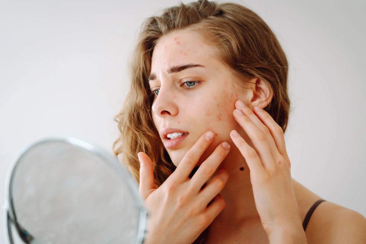 Woman examining sun damage and hyperpigmentation before a chemical peel treatment to improve uneven skin tone and brighten the complexion at Optimal Health Family Practice and Medspa.