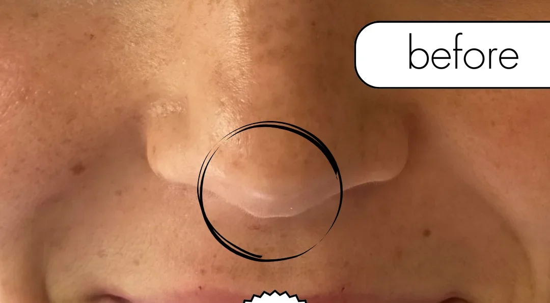 Nose Tox treatment, before